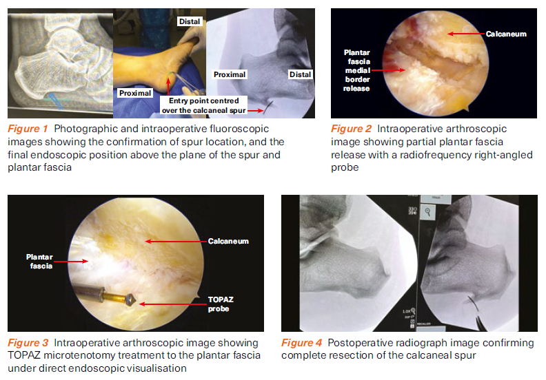 Minimally invasive deformity correction technique - SingHealth Duke-NUS Spine Centre