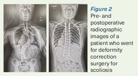 Deformity correction surgery for scoliosis - SingHealth Duke-NUS Spine Centre