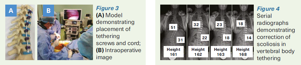 Vertebral body tethering - SingHealth Duke-NUS Spine Centre