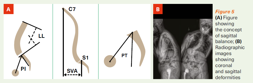 Managing Adult Spinal Deformities - SingHealth Duke-NUS Spine Centre