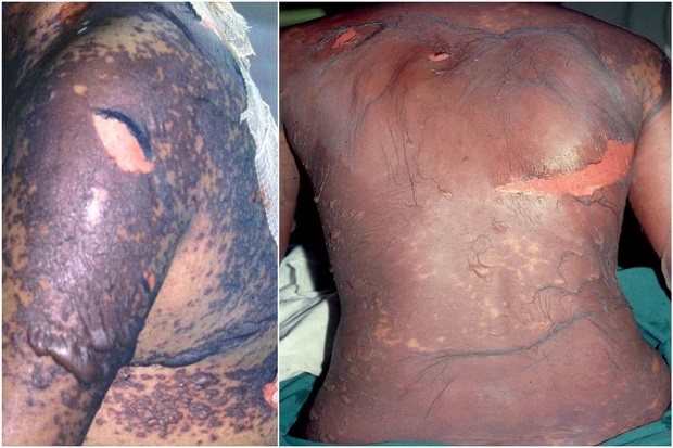  ​Between February 2024 and February 2025, seven men and two women were hospitalised after consuming these medicines. PHOTO NATIONAL SKIN CENTRE 