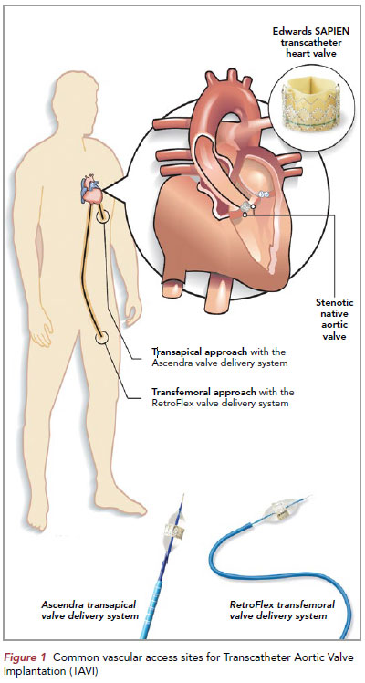 Common vascular access sites for TAVI - National Heart Centre Singapore