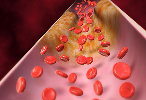 Blog Article: Why lower LDL (bad cholesterol) and how to lower LDL?