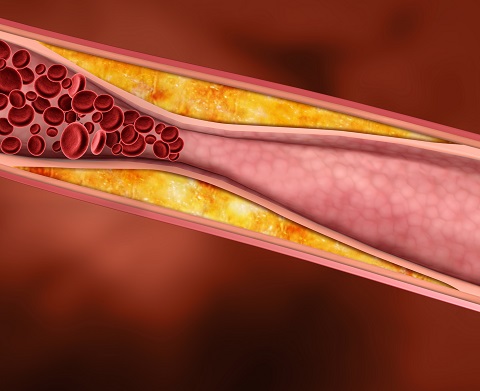 illustration narrowed heart artery