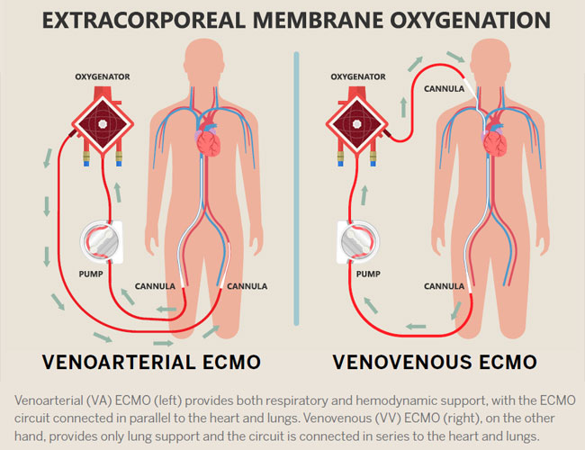 va and vv ecmo illustration