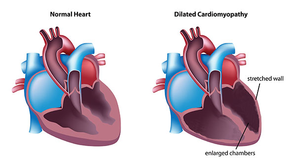normal heart vs heart with dilated cardiomyopathy