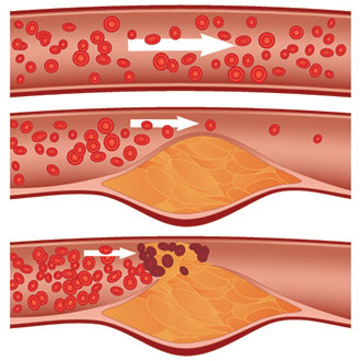 blocked coronary artery