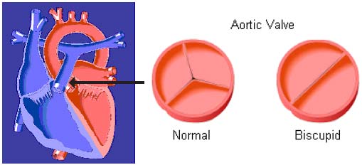 bicuspid aortic valve conditions & treatments