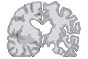 A Magnetic Resonance Imaging (MRI) or Computed Tomography (CT) scan looks for a treatable cause of dementia or the presence of atrophy (shrinkage) in the brain