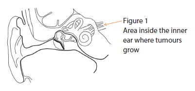 Acoustic Neuroma Condition and Treaments SingHealth