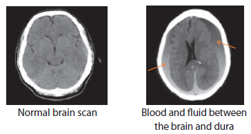 chronic subdural haemorrhage conditions & treatments