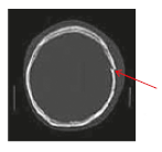 Depressed skull fracture