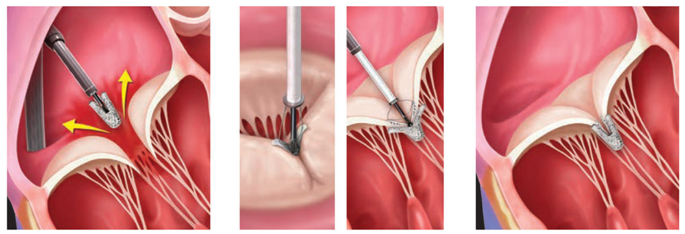 TriClip procedure illustration