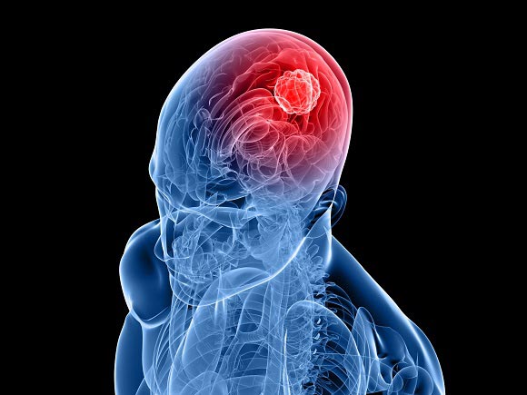 Brain cancer is abnormal and uncontrolled cell growth in the brain or surrounding tissues | SingHealth