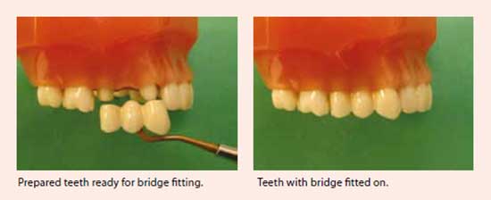 Bridges treatment at National Dental Centre Singapore