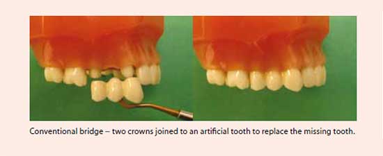 Conventional bridge treatment at National Dental Centre Singapore