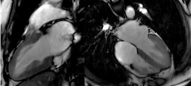 Cardiac Magnetic Resonance (CMR) scan