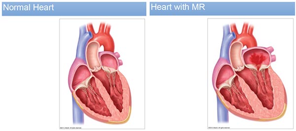 mitraClip procedure conditions & treatments