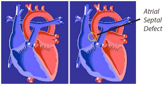 atrial septal defect illustration