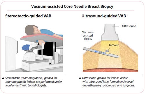 breast cancer diagnosis - vacuum-assisted core needle breast biopsy