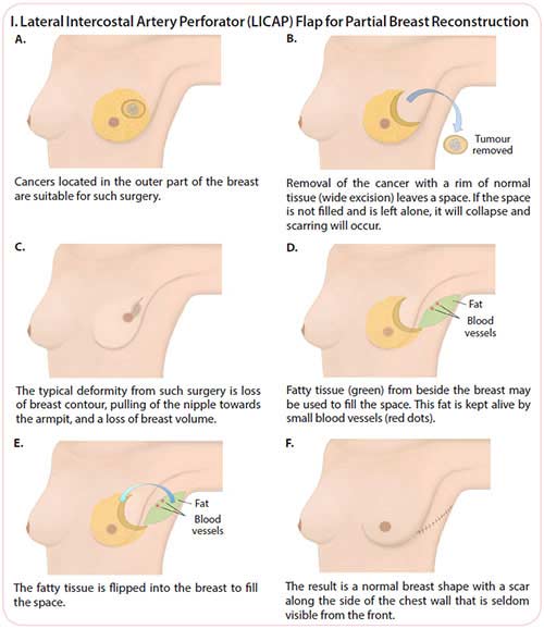 Breast Cancer Surgery Types