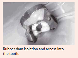 Root canal treatment at National Dental Centre Singapore.