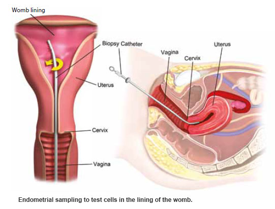 Menorrhagia Endometrial sampling - condition and treatment SingHealth