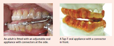 manage snoring or osa with oral appliances