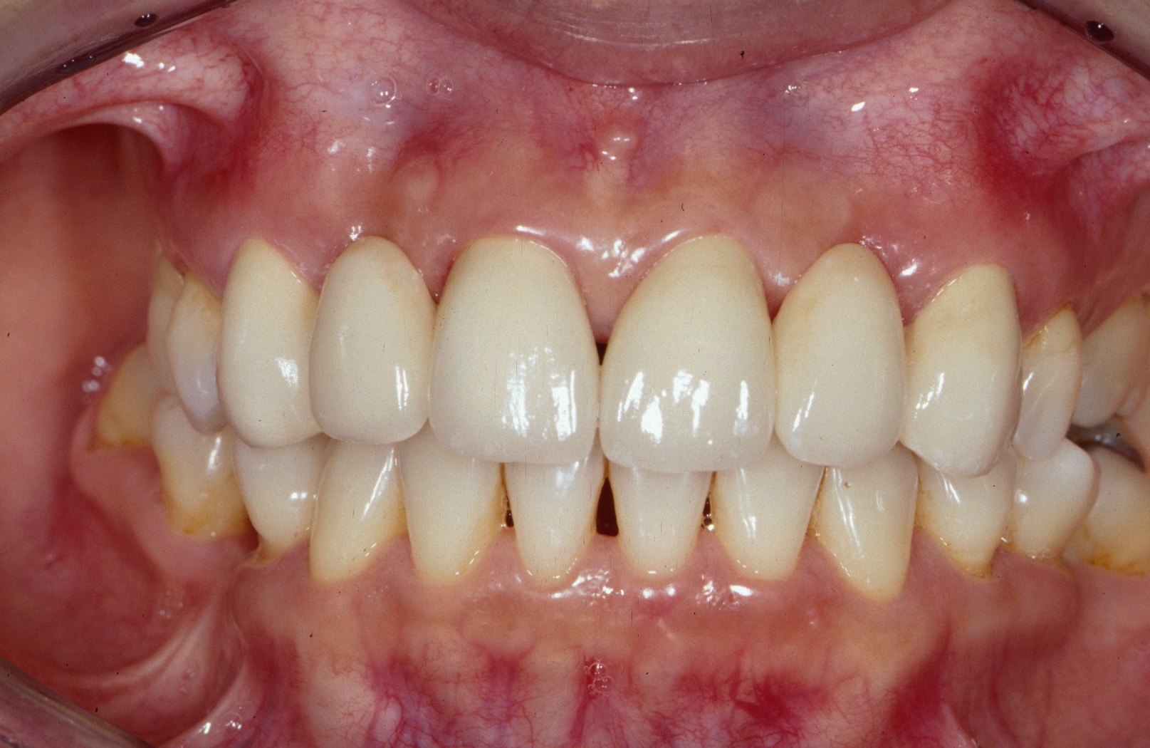 Cement is used to bond the bridge structure to the back of these teeth, according to the National Dental Centre Singapore