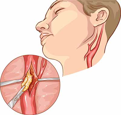 carotid endarterectomy conditions and treatments