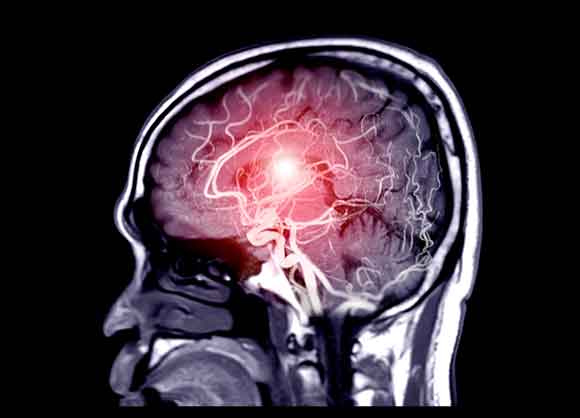 cerebral aneurysm conditions and treatments