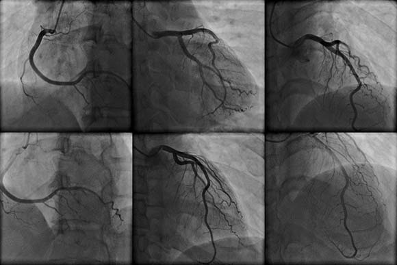 coronary angiography heart diagnostic test