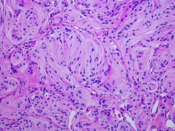 meningiomas conditions & treatments