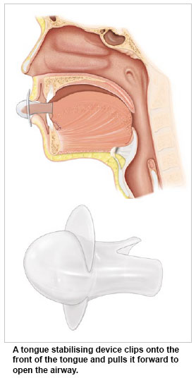 Tongue stabilising device - SingHealth Duke-NUS Sleep Centre