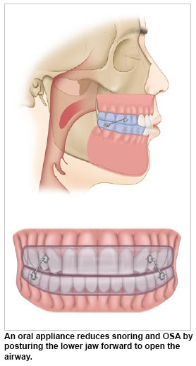 Oral appliance reduces snoring - Obstructive Sleep Apnoea (OSA) Conditions and Treatments