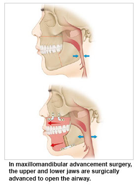 Maxillomandibular advancement surgery - Obstructive Sleep Apnoea (OSA) Conditions and Treatments